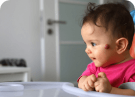 Enfant avec un hémangiome sur la joue
