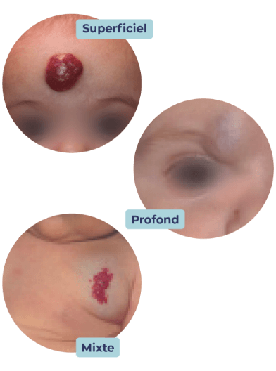 Exemple d'hémangiome superficiel, profond et mixte