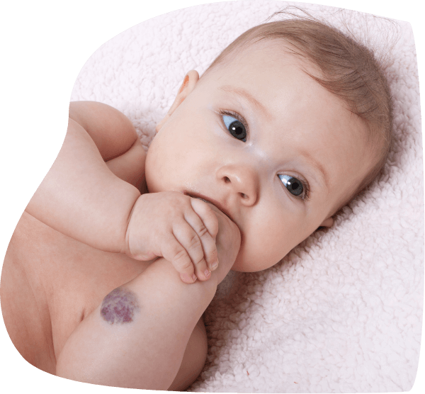 Bébé avec hémangiome au bras